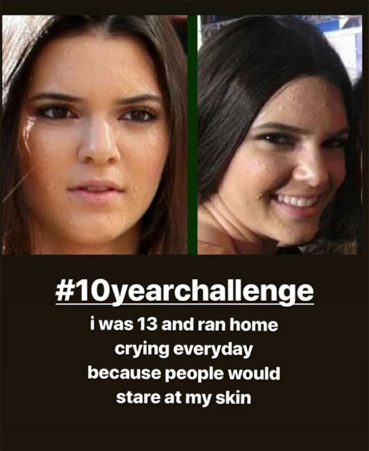 Kendall Jenner con acné