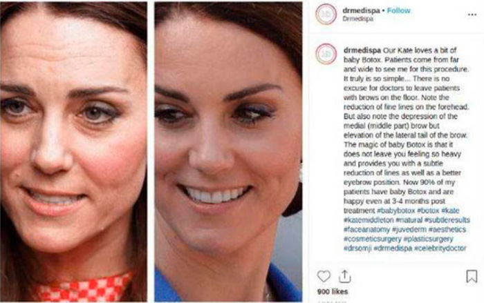Kate Middleton señalada por usar botox