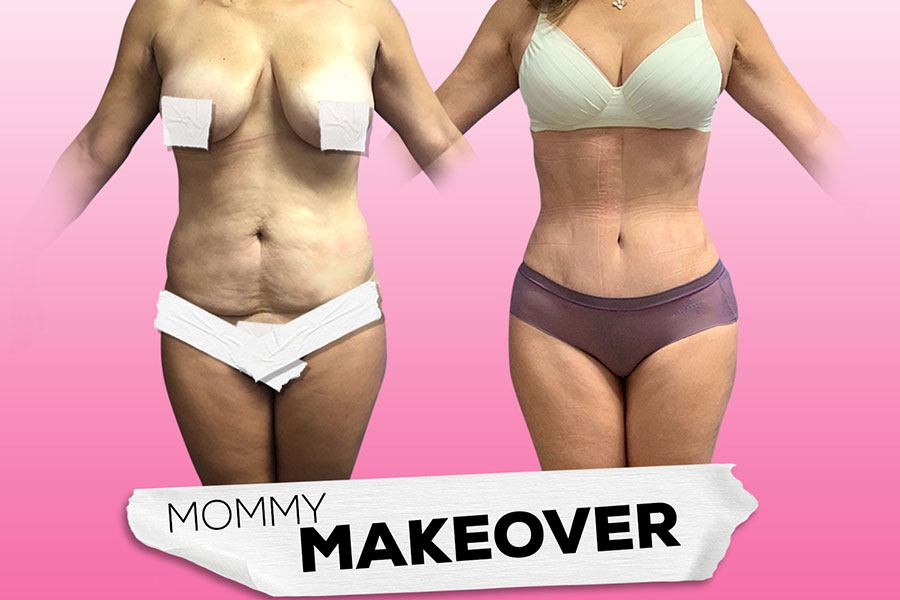 Mommy makeover