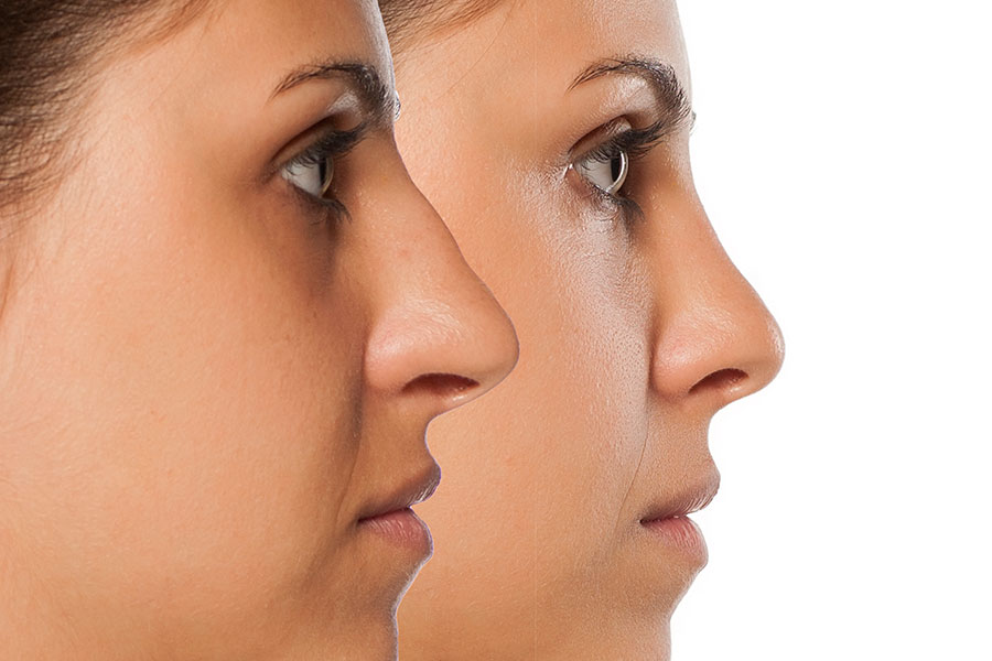 La rinoplastia es una de las cirugías estéticas más comunes.