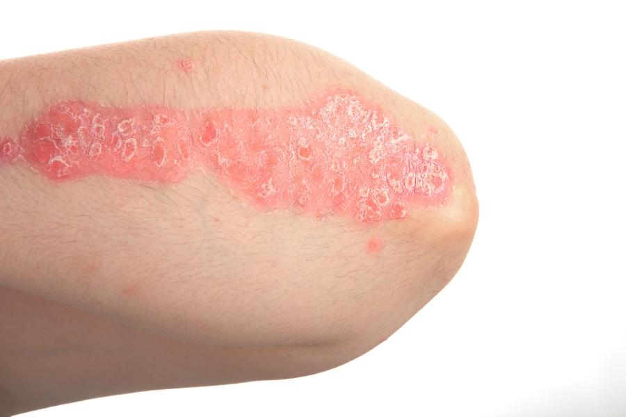 la psoriasis es una enfermedad de la piel y estos son sus síntomas